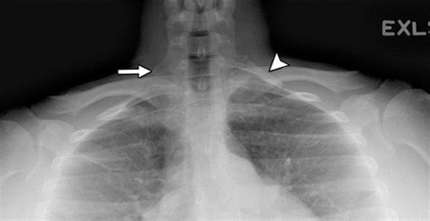 cervical compression test thoracic outlet syndrome|thoracic outlet syndrome x ray.